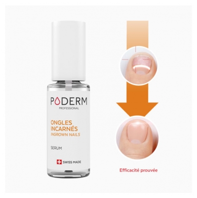 Poderm Ongles Incarnés 8ml