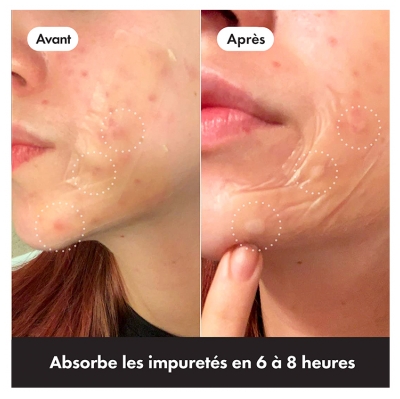 Hero – Mighty Patch Surface – Patchs Anti-Acné Jour et Nuit Pour Les Zones Étendues – Boîte de 10 Patchs