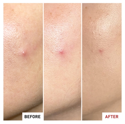 sErborian Centella SOS Patch Gel Anti-Imperfectionx 10% PHA 9 ml