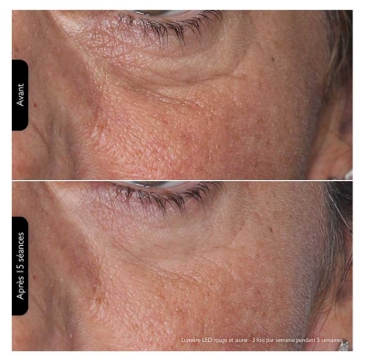 Silk'n Visage Masque LED 100