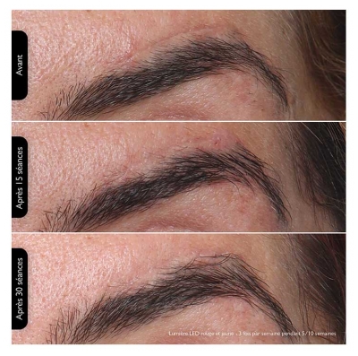 Silk'n Visage Masque LED 100